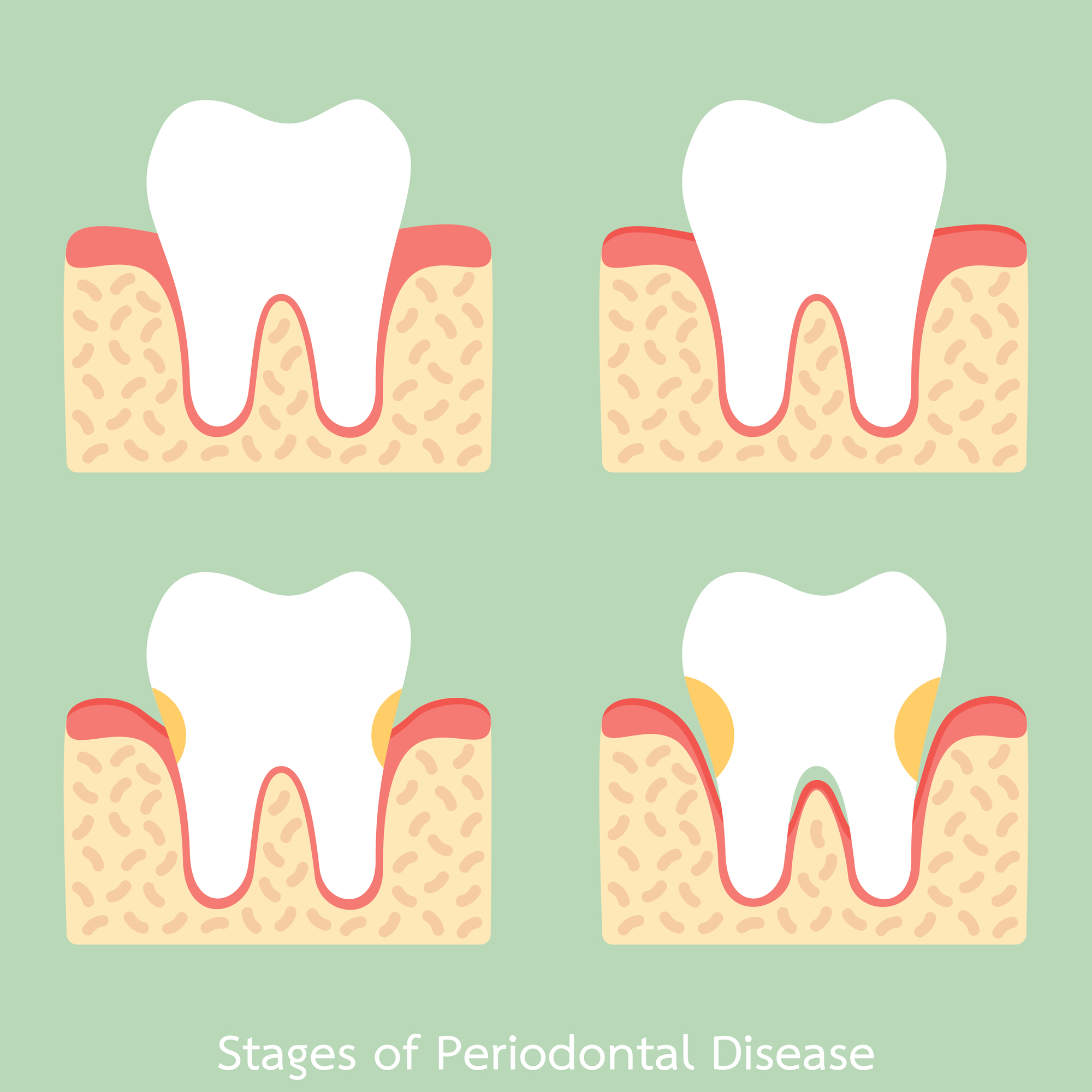 stages of gum disease Periodontal periodontitis problem gingivitis ...